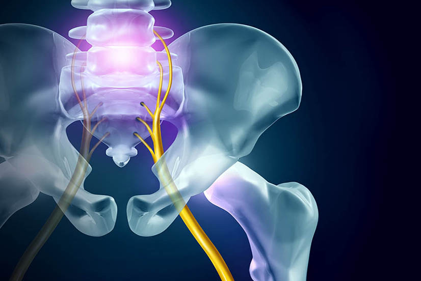Treating sciatica with chiropractic in Margate, Coconut Creek and Coral Springs