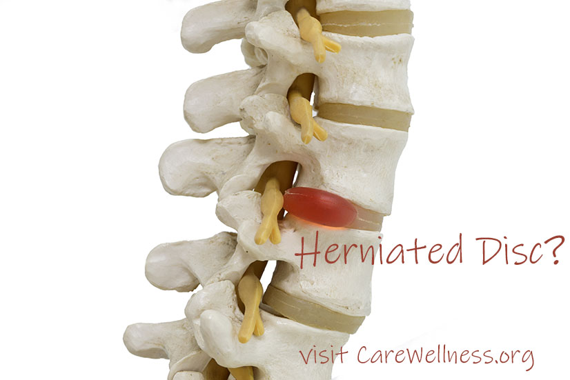 Herniated disc treatment in Coconut Creek, Margate and Coral Springs with Dr. Adam J. Friedman.