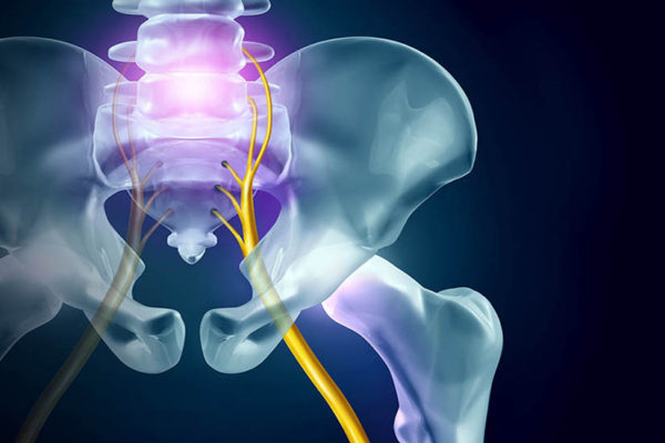 Treating Sciatica with Chiropractic