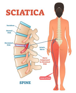 Sciatica Treatment with Chiropractic in Coral Springs Coconut Creek and Margate Florida