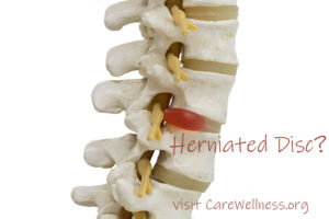Treatment for Herniated Discs in South Florida