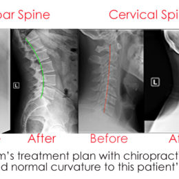 X-Ray Before and After Chiropractic Care