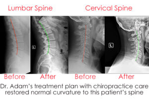 Before and After Xrays show improvement of spinal curve with chiropractic care