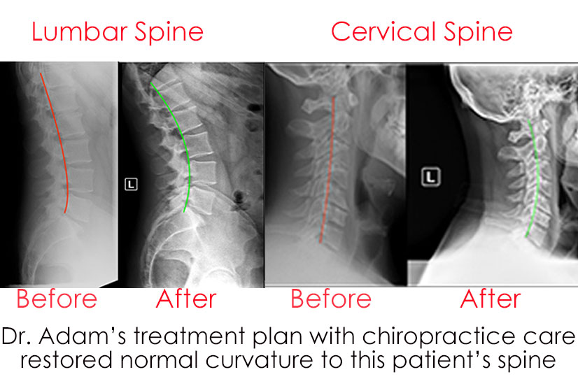 Before and After X rays show improvement of spinal curve with chiropractic care